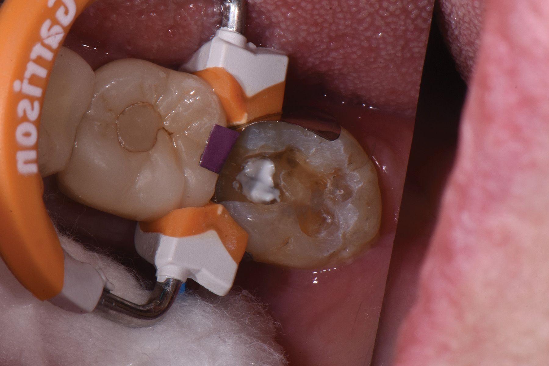 The Latest Trends in Dental Pulp Capping Materials