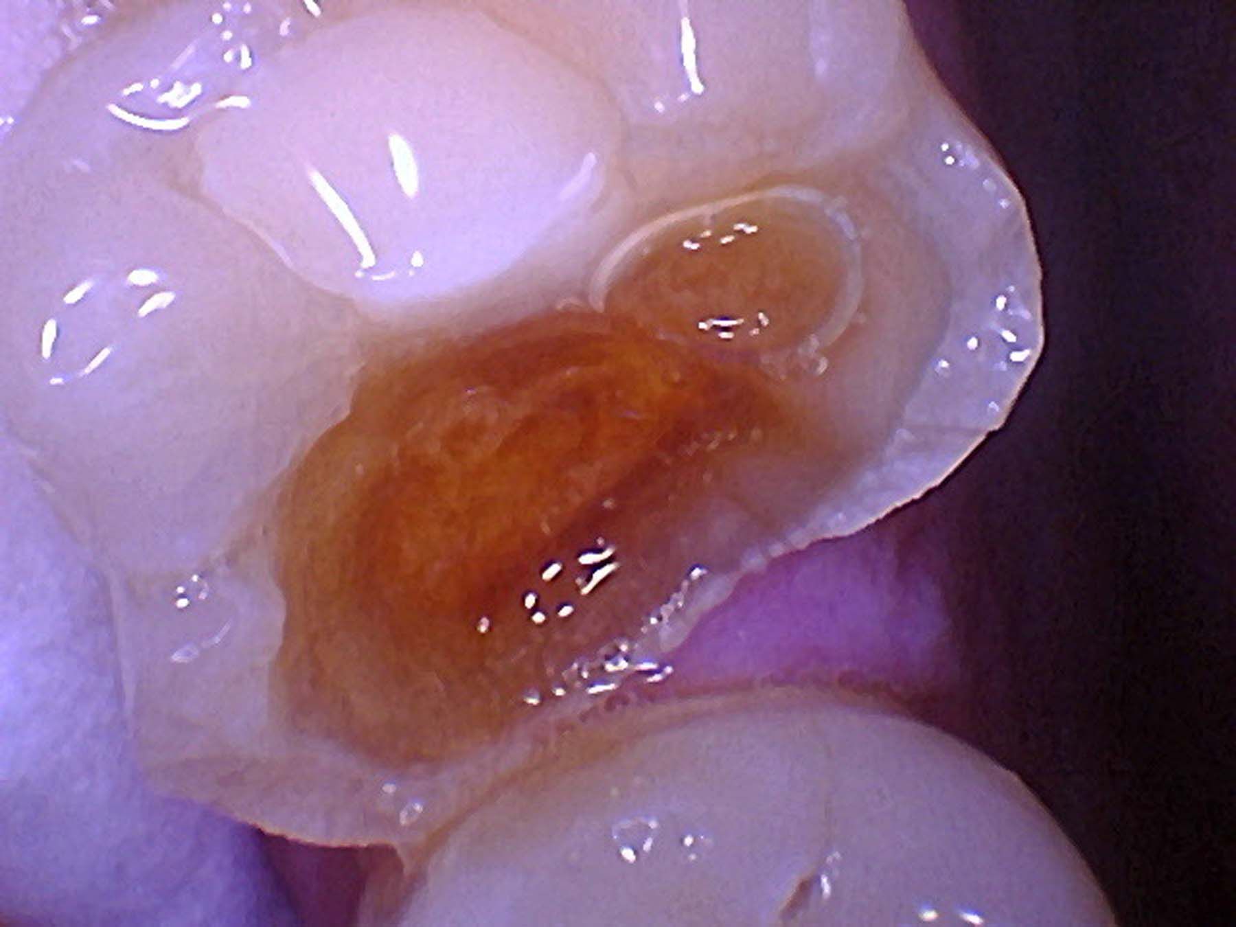 Figure 5.  A patient presented to our office with an asymptomatic No. 14 with missing mesiolingual and mesiobuccal cusps. Both the patient and I preferred to avoid endodontic therapy. Decay was noted.