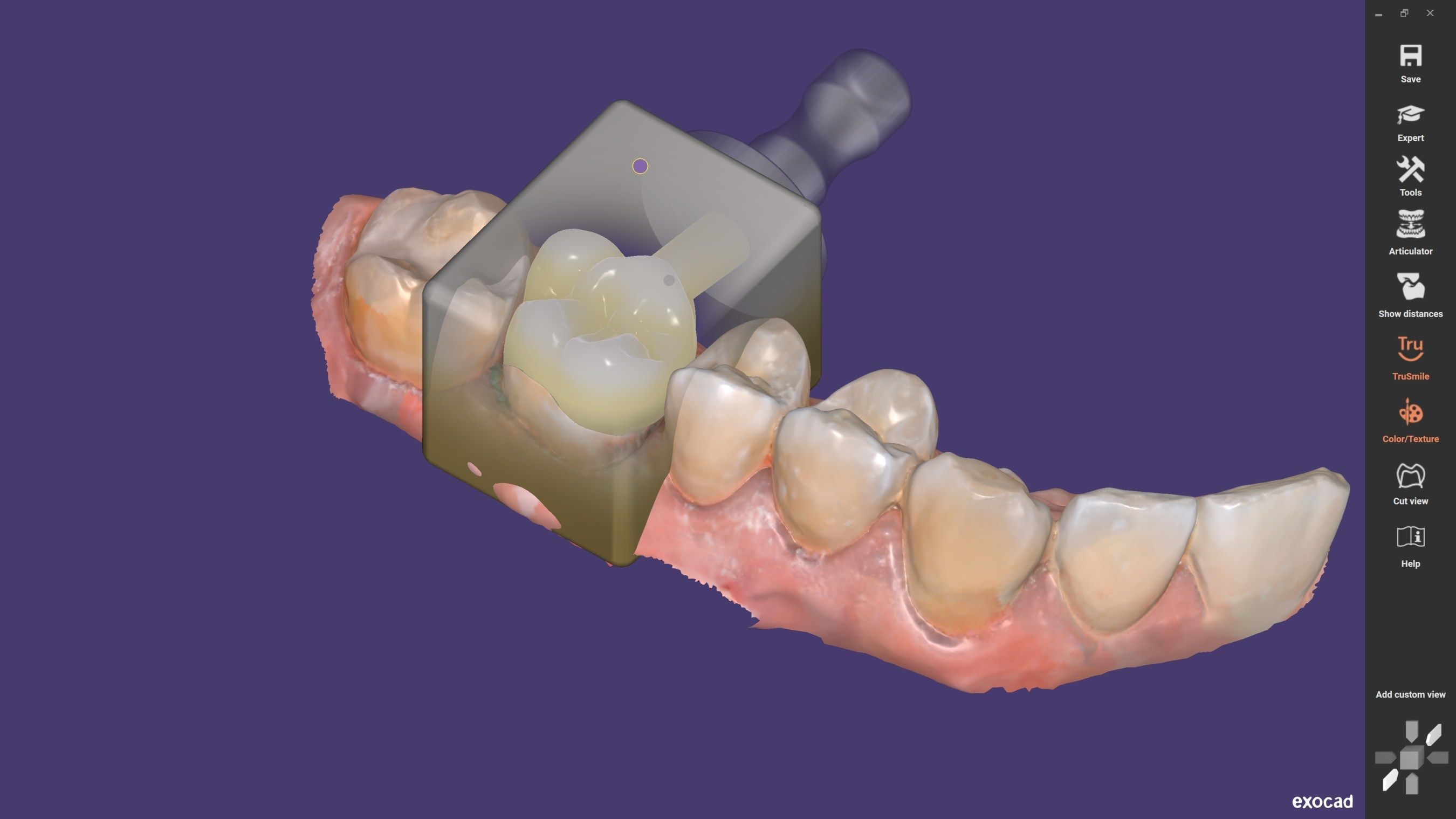 A crown design is prepared for milling using ChairsideCAD from exocad | image © exocad