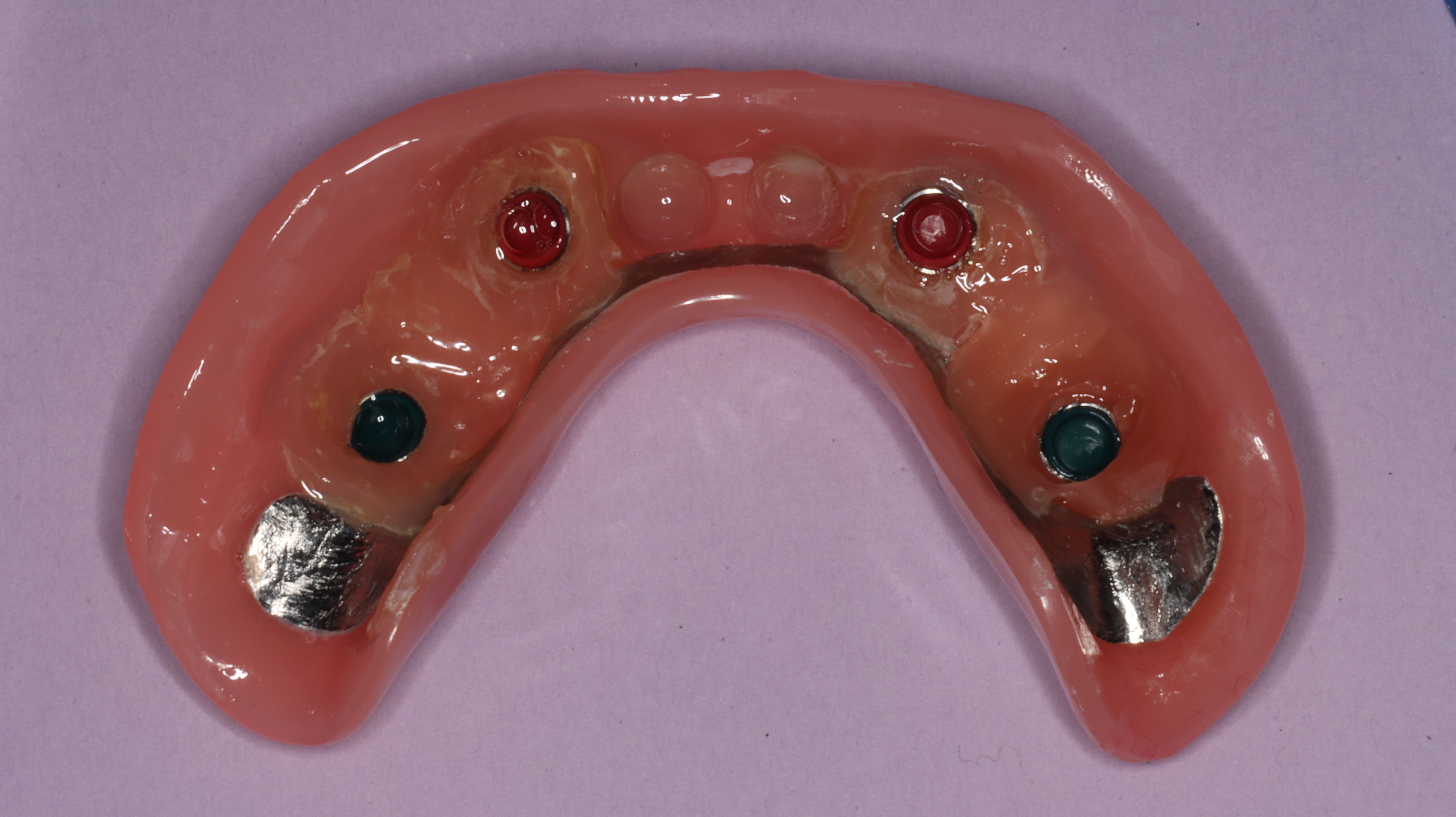 Figure 22. Intaglio view of overdenture following intra-oral cold cure pickup of locator attachments immediately following surgery.