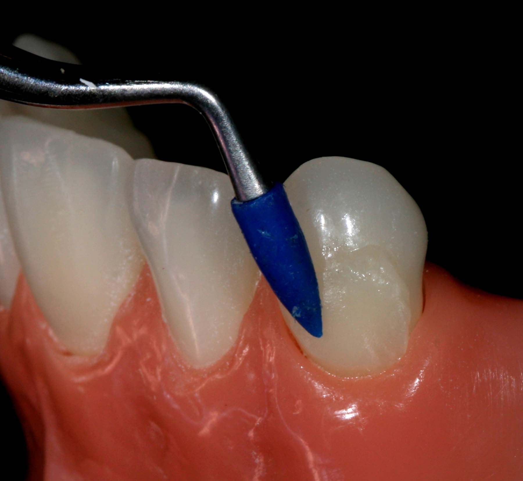 Figure 10. OMNICHROMA final placement with OptraSculpt