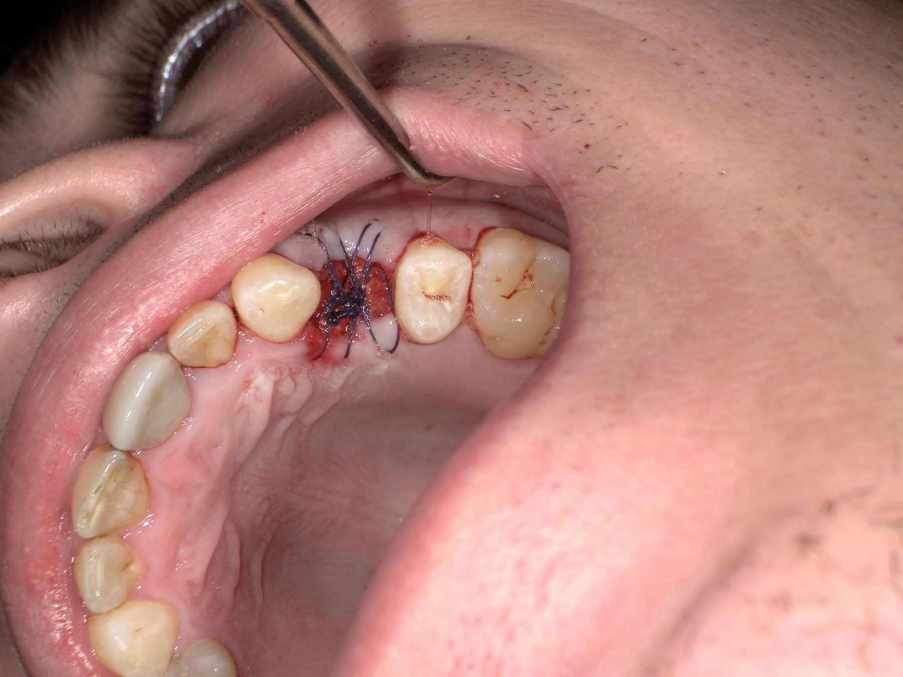 Figures 8-9. Postoperative  images from case 1.