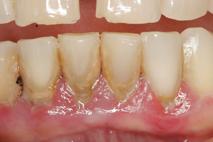 perio tray before and after