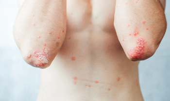 Body with Psoriasis