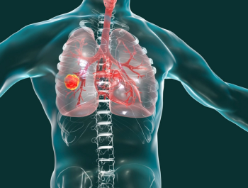 NSCLC
