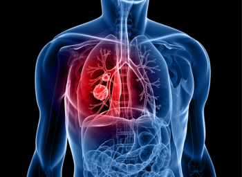 lung cancer