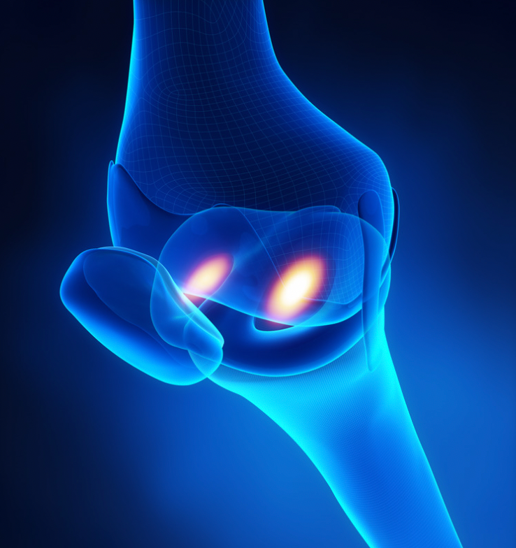 rheumatoid arthritis joint and bone xray