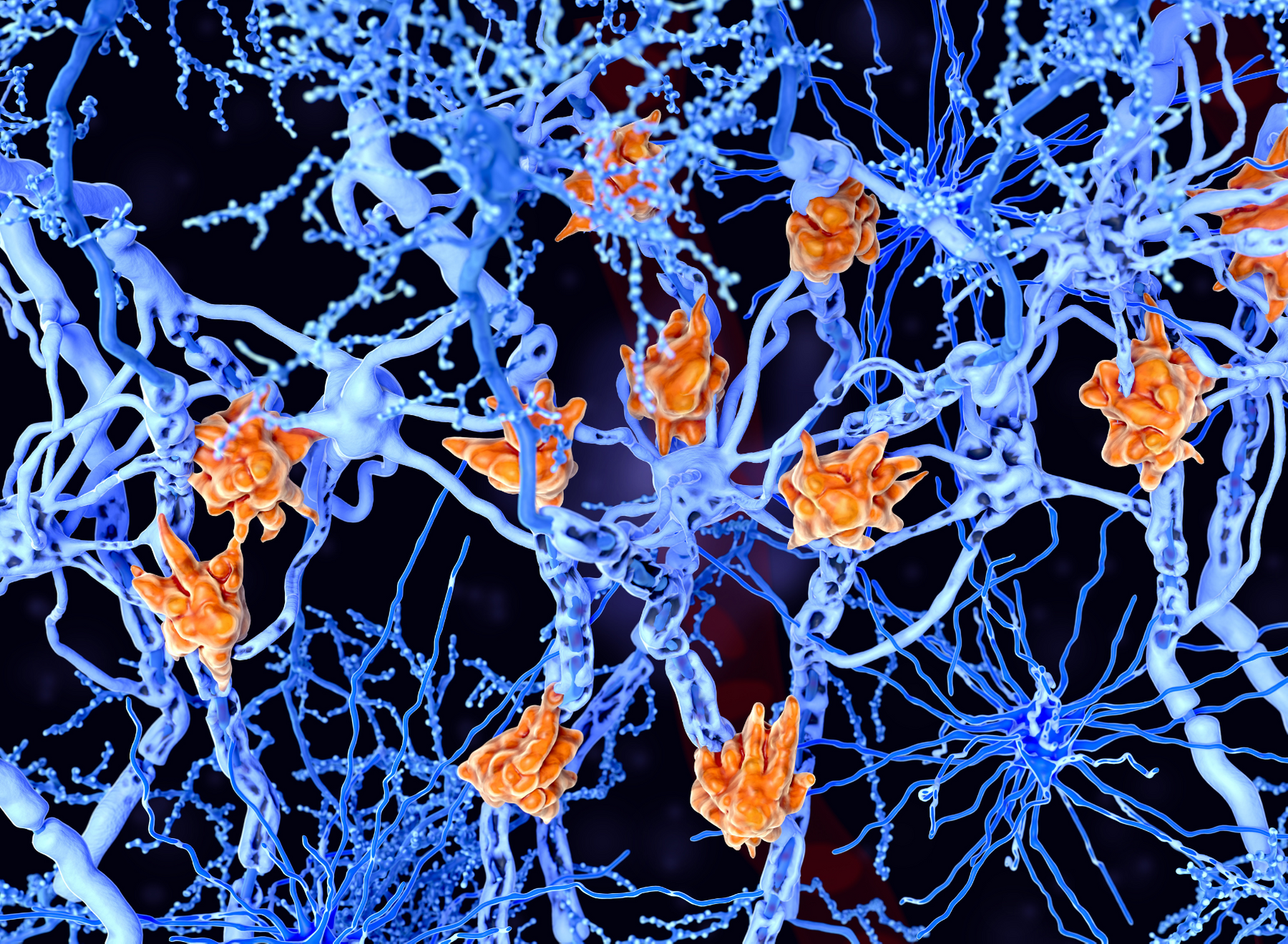 multiple sclerosis