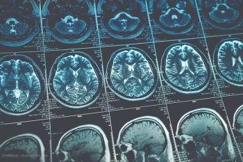 MRI brain scan