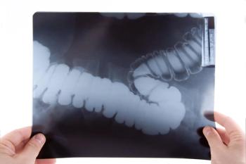 Ulcerative Colitis