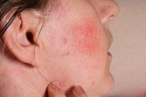 What’s New in Acne and Rosacea?