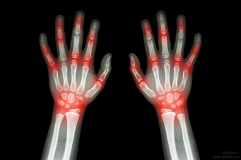 Rheumatoid Arthritis