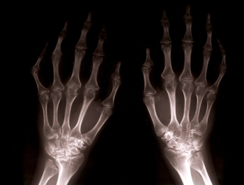 Arthritis
