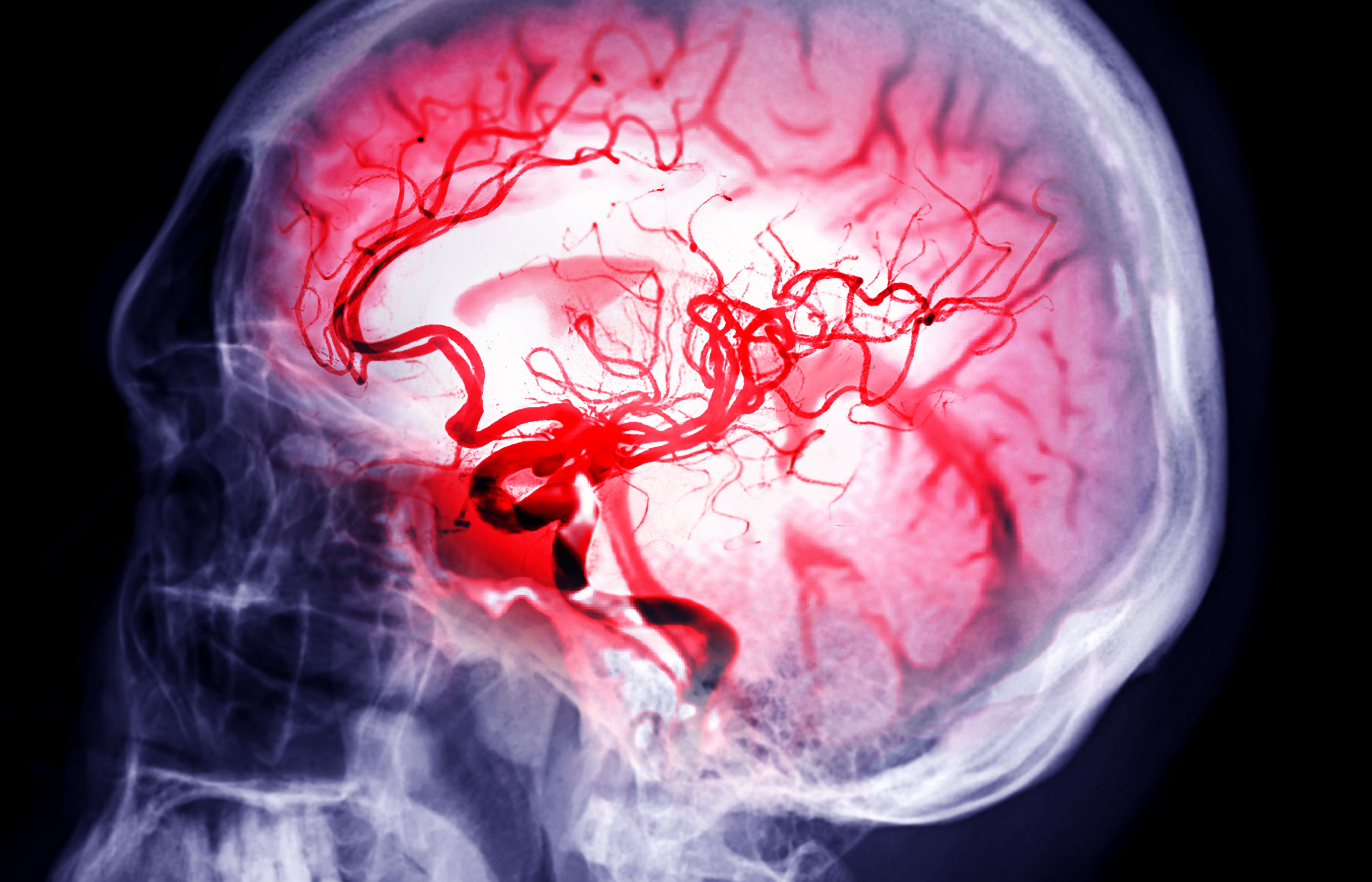 <![CDATA[Investigational Asundexian Shows Reduction in Ischemic Stroke]]>