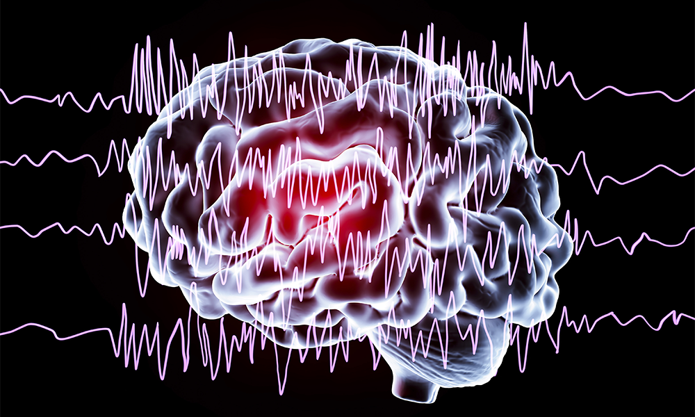 Epilepsy
