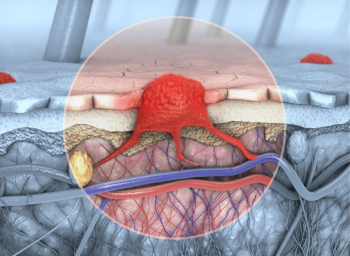 melanoma