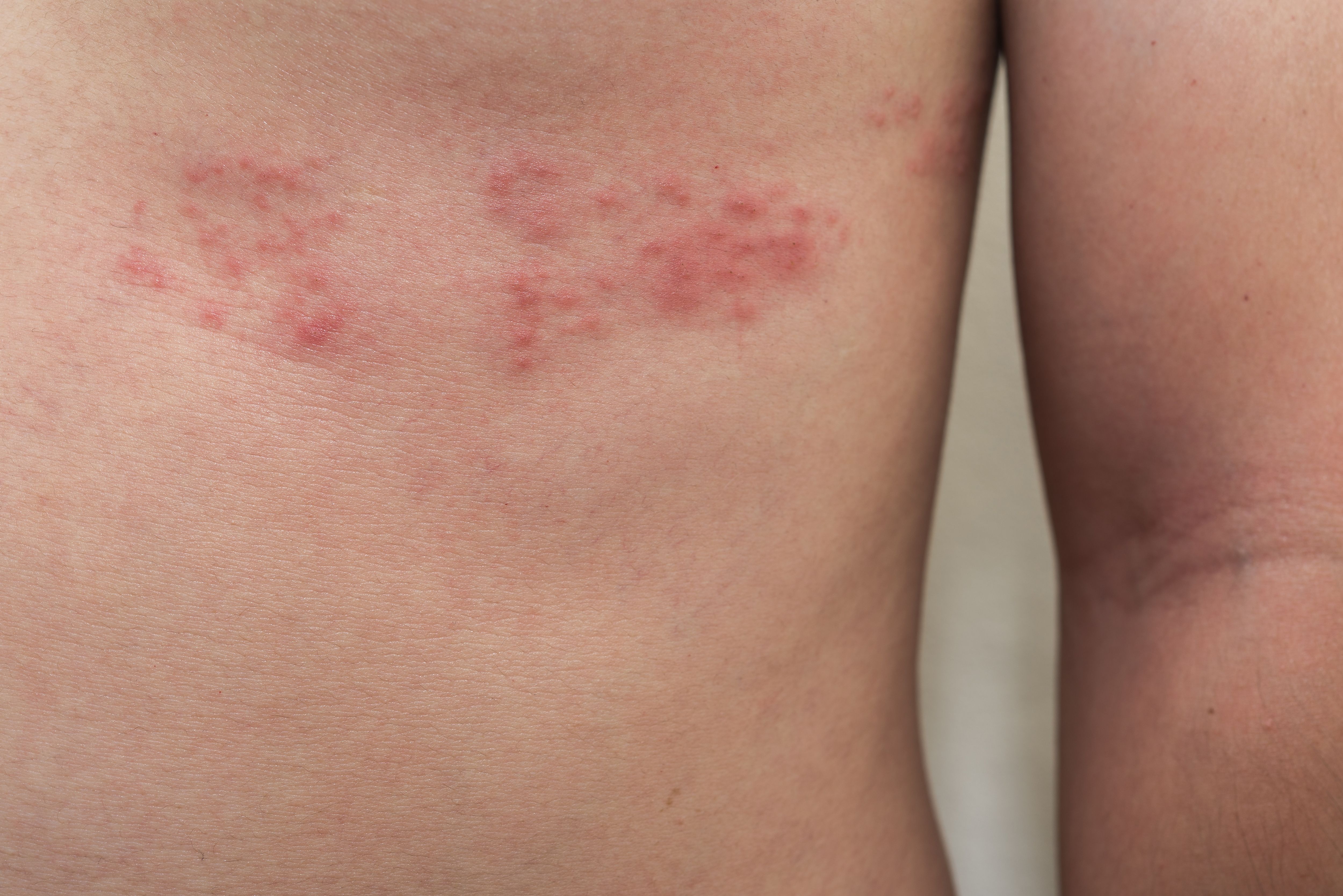 The Stages Of Shingles the-stages-of-shingles