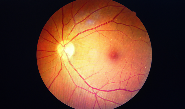 Diabetic Retinopathy