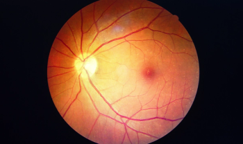 Diabetic Retinopathy