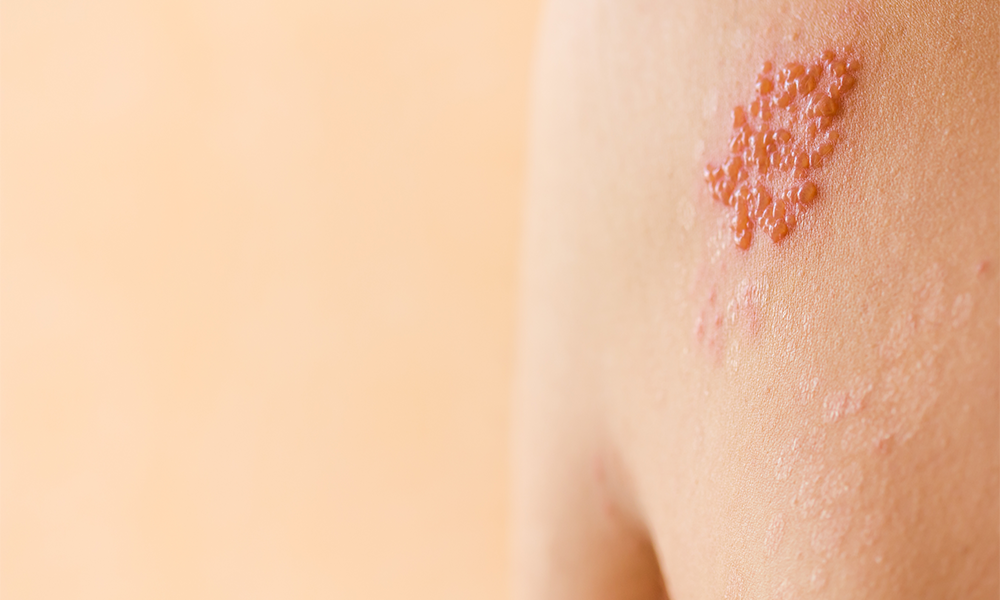 Shingles Among Most Painful Medical Conditions