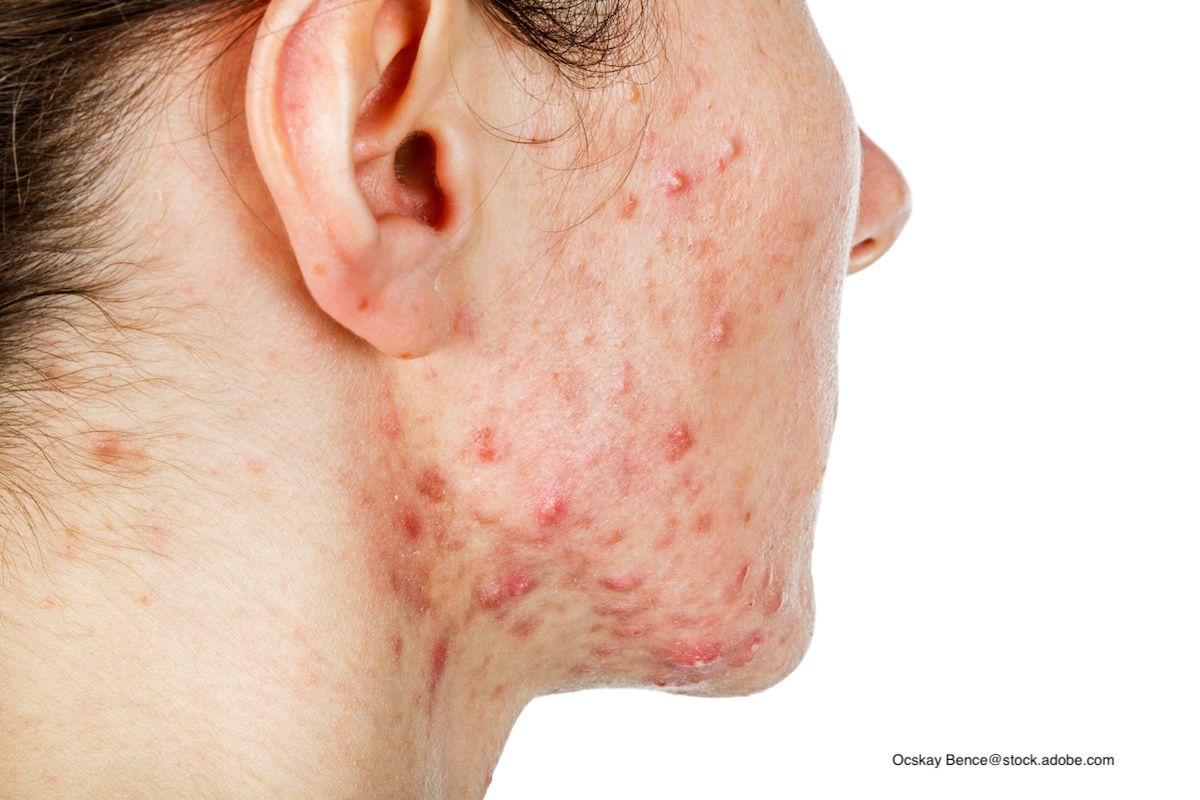 Isotretinoin Cost Cvs