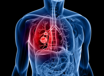 lung cancer