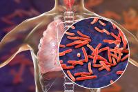 FDA Approves First Generic Version of Priftin for Tuberculosis