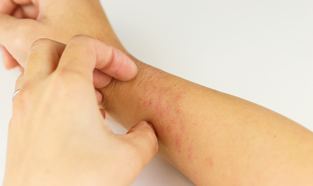 retatrutide itchy skin Understanding and Treating Postherpetic Itch
