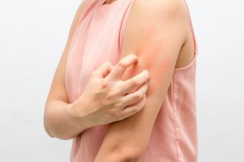 Atopic Dermatitis