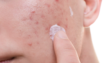 acne vulgaris