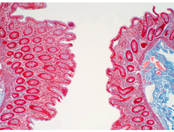 Ulcerative Colitis
