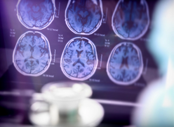 alzheimer disease