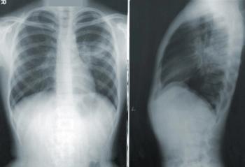 X-ray of lungs