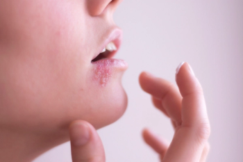 oral shingles