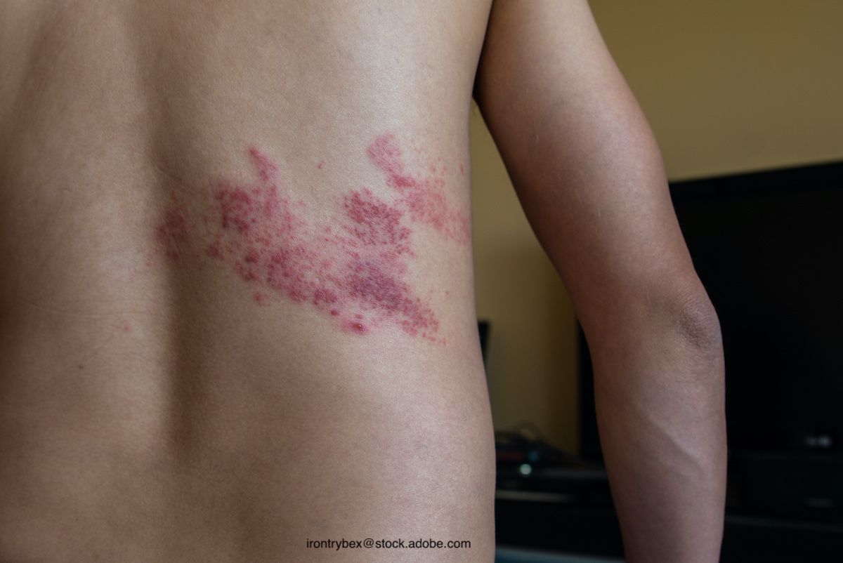 Multidermatomal Shingles Leg Dermatome