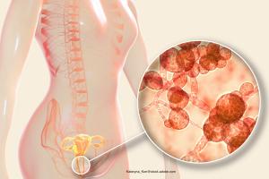 Vivjoa Approved for Recurrent Vulvovaginal Candidiasis