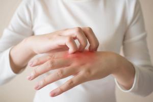 Dupilumab Effective In Treating Atopic Hand and Foot Dermatitis