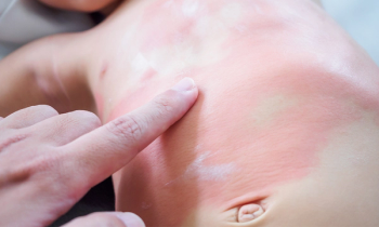pediatric urticaria