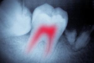 OTC Remedies Help With Oral Pain Management