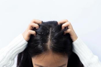 seborrheic dermatitis dandruff | Image Credit: Parkin - stock.adobe.com