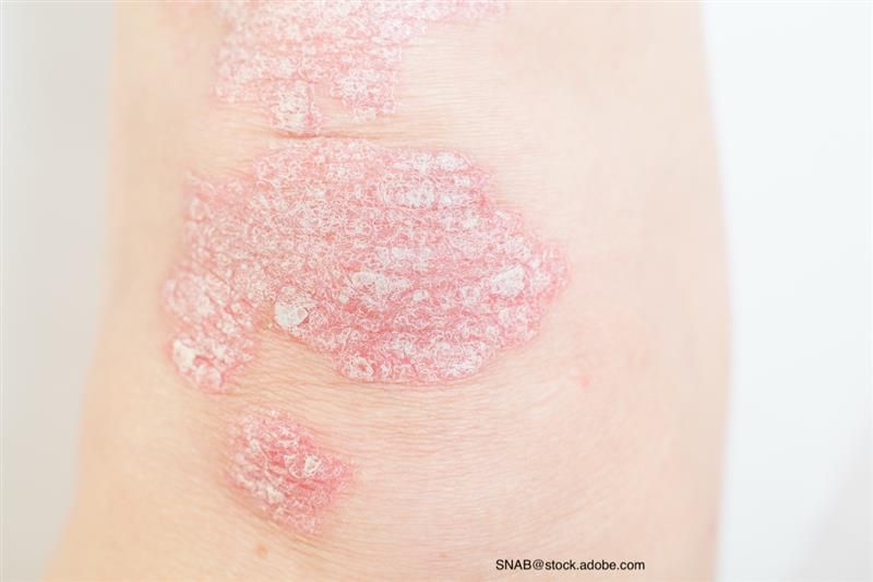 Plaque Psoriasis Treatment Gets Even More Company