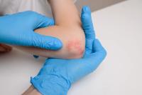 FDA Approves Skyrizi for Pediatric Plaque Psoriasis, Psoriatic Arthritis