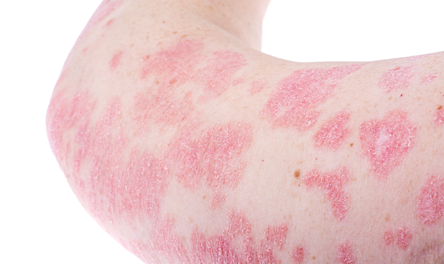 Plaque Psoriasis on Arm
