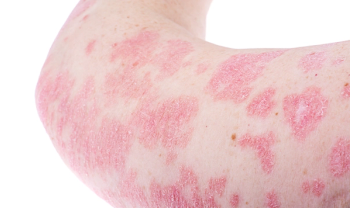 Plaque Psoriasis on Arm