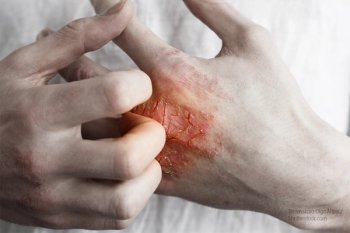 Rash