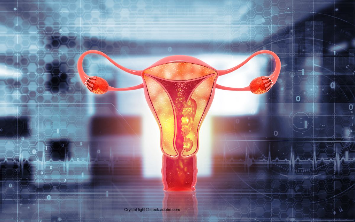 Positive Phase 3 Results for Jemperil Found for Endometrial Cancer ...