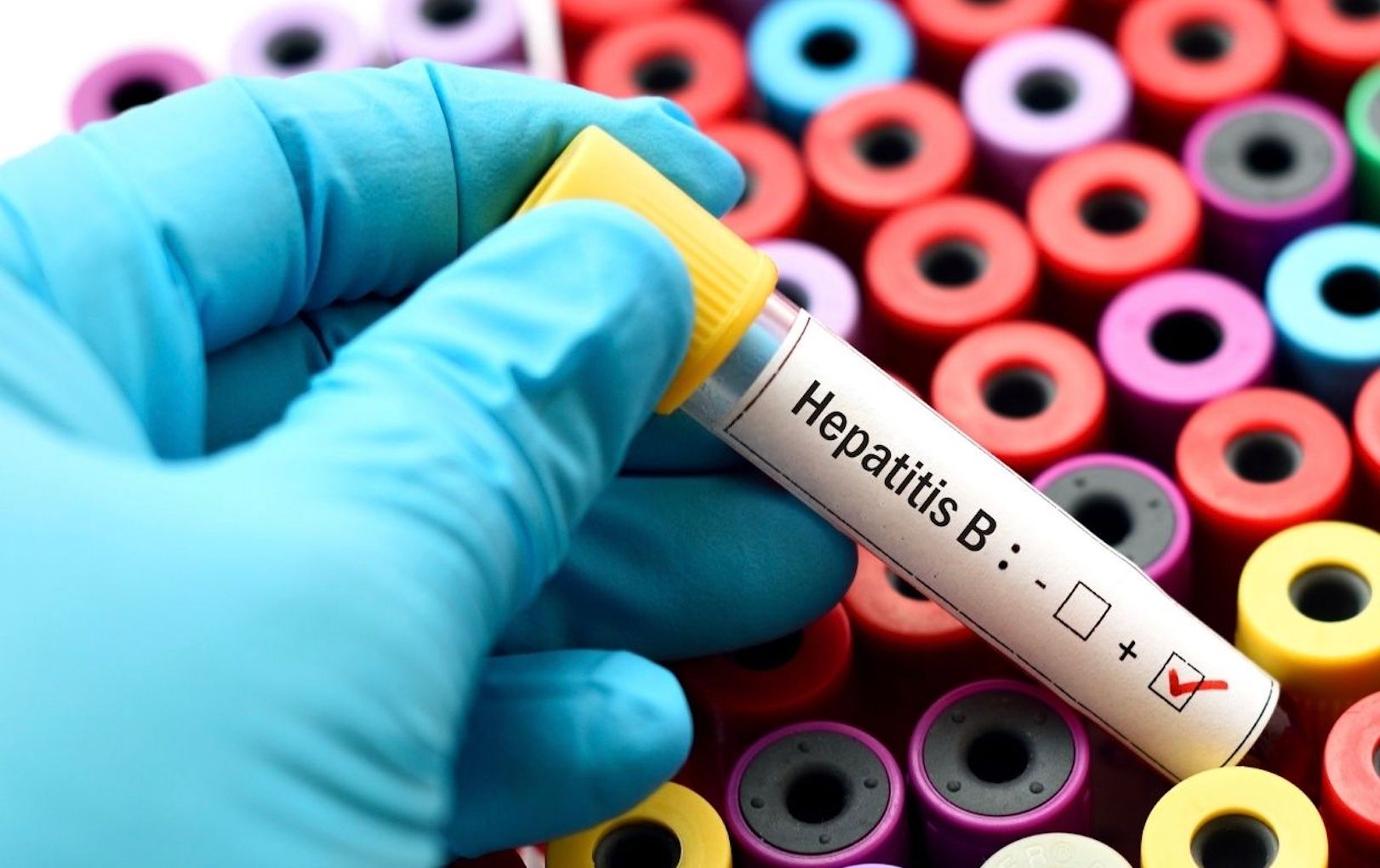 hepatitis b