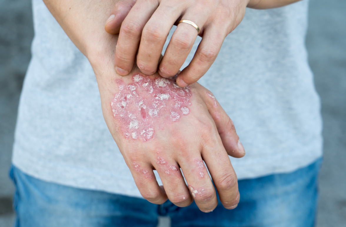 psoriasis on hands 