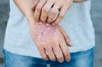psoriasis on hands 