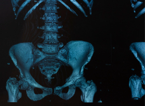 multiple myeloma